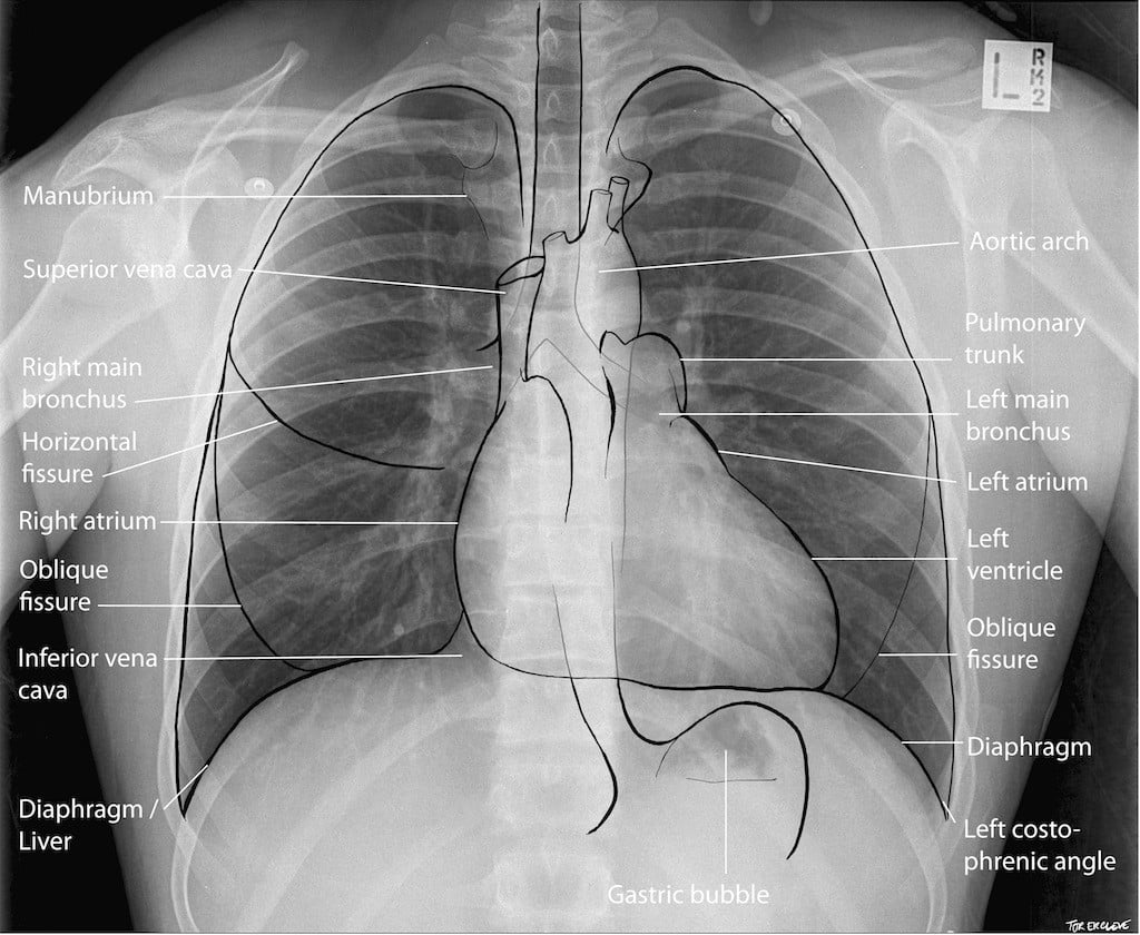 Normal-CXR-Labelled